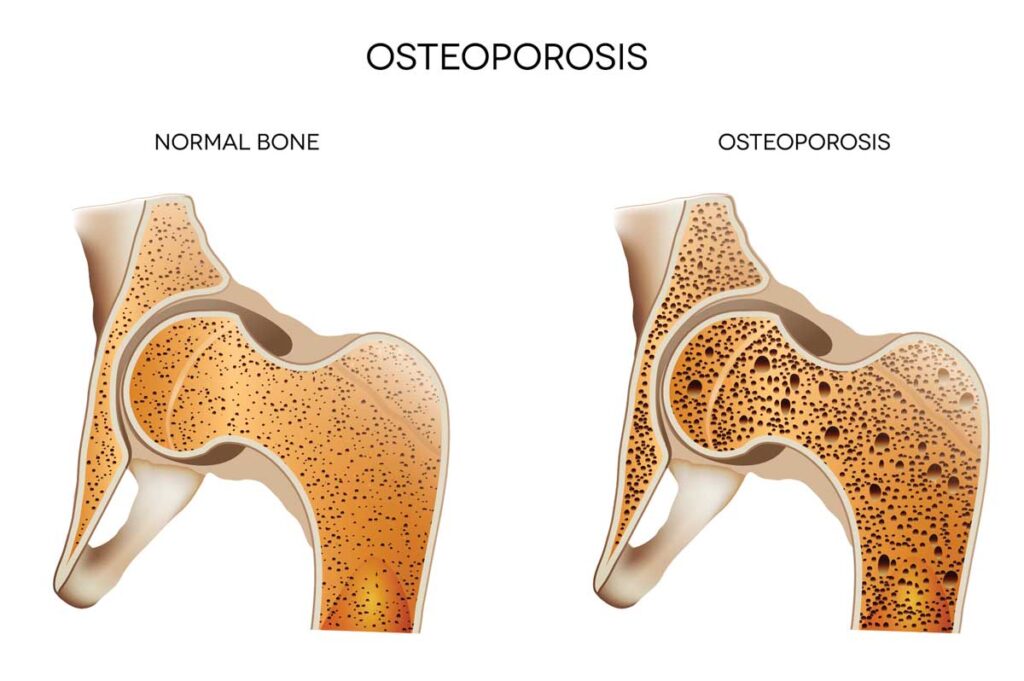 Osteoporosis Arthritis and Osteoporosis Associates